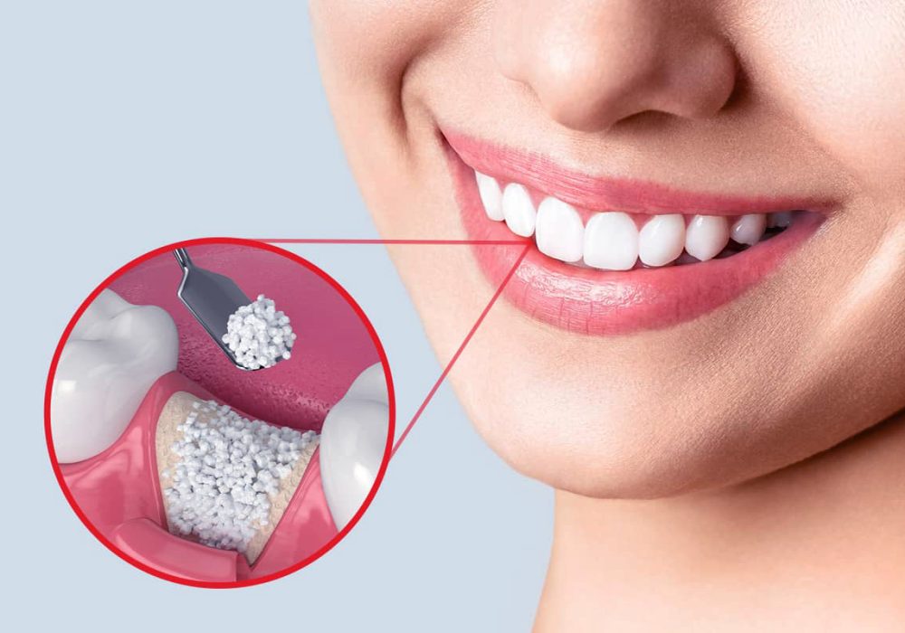 dental-bone-grafting