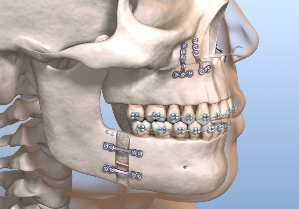 voce-sabe-como-e-o-processo-de-recuperacao-da-cirurgia-ortognatica-1625589028